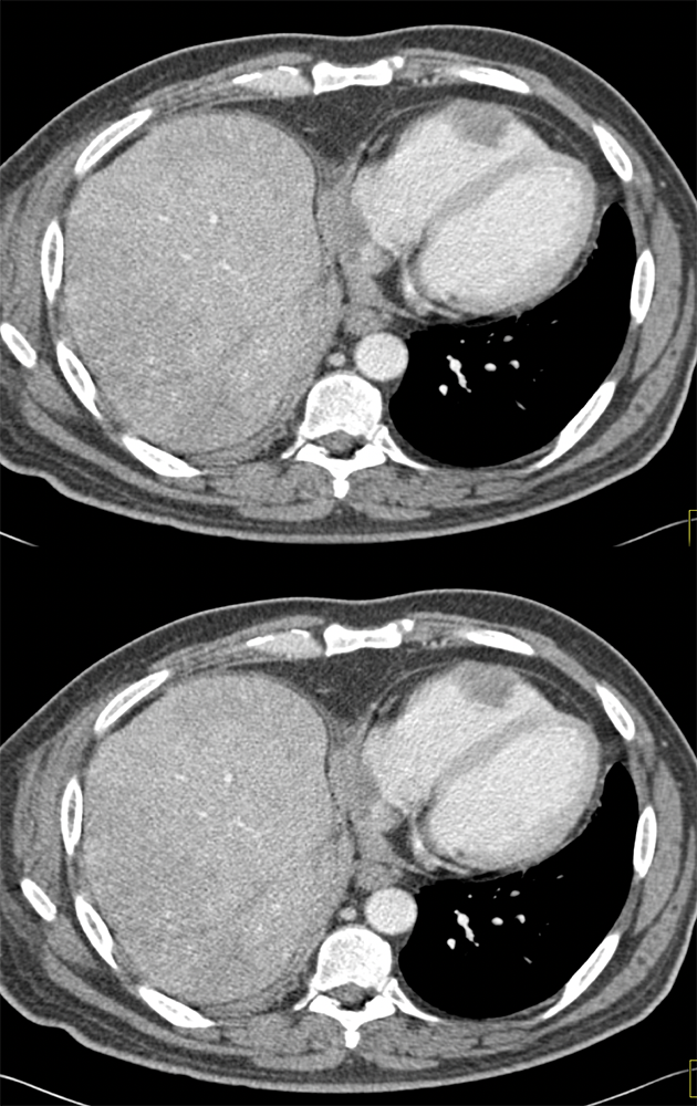 Adenoid Cystic Tumor Metastatic to the Right Ventricle