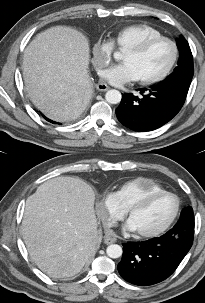 Adenoid Cystic Tumor Metastatic to the Right Ventricle