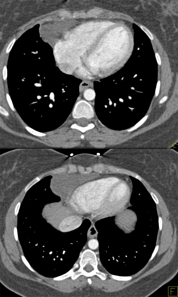 Pericardial Cyst