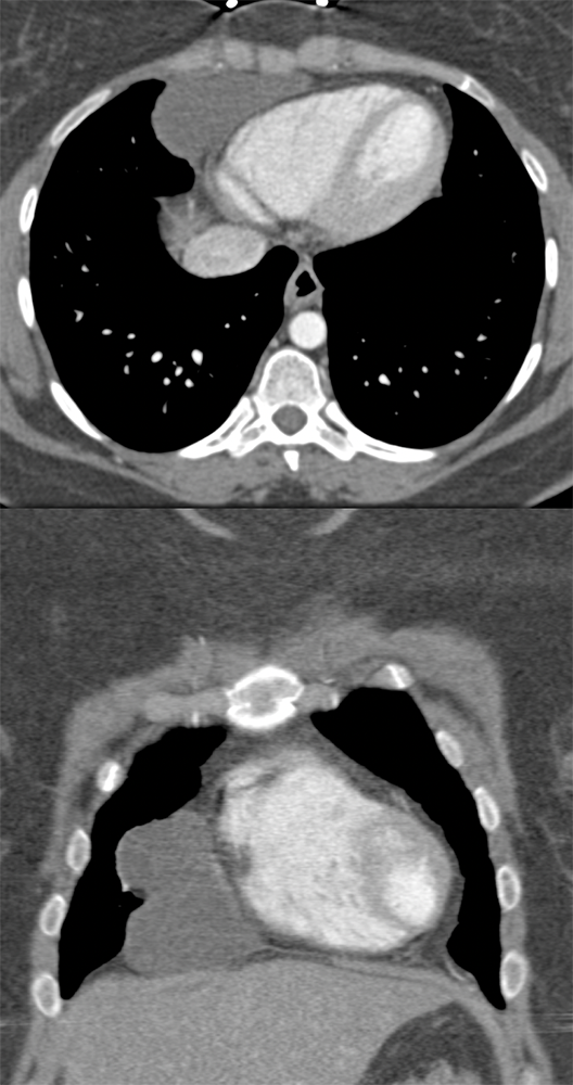 Pericardial Cyst