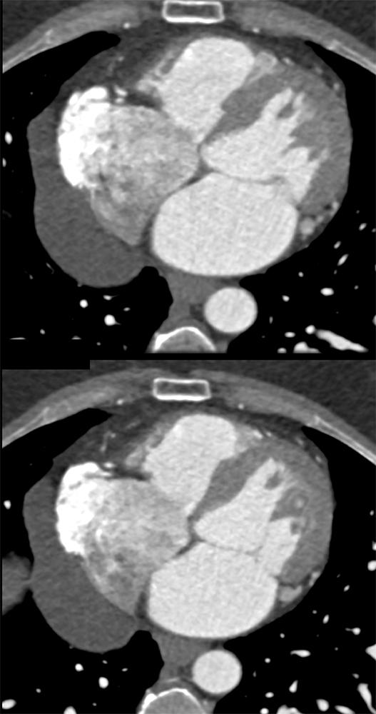 Pericardial Cyst