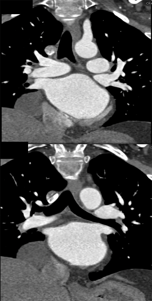 Pericardial Cyst