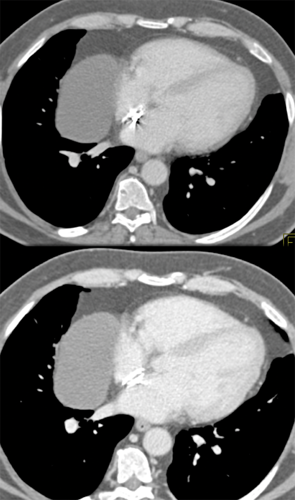 Pericardial Cyst 