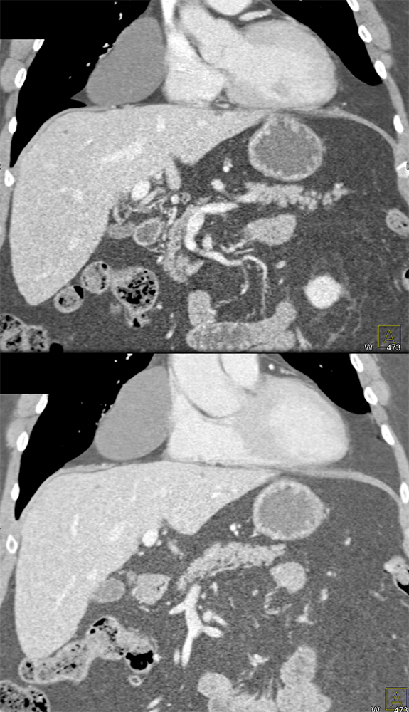 Pericardial Cyst 