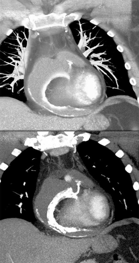 Partially Calcified Pericardial Cyst