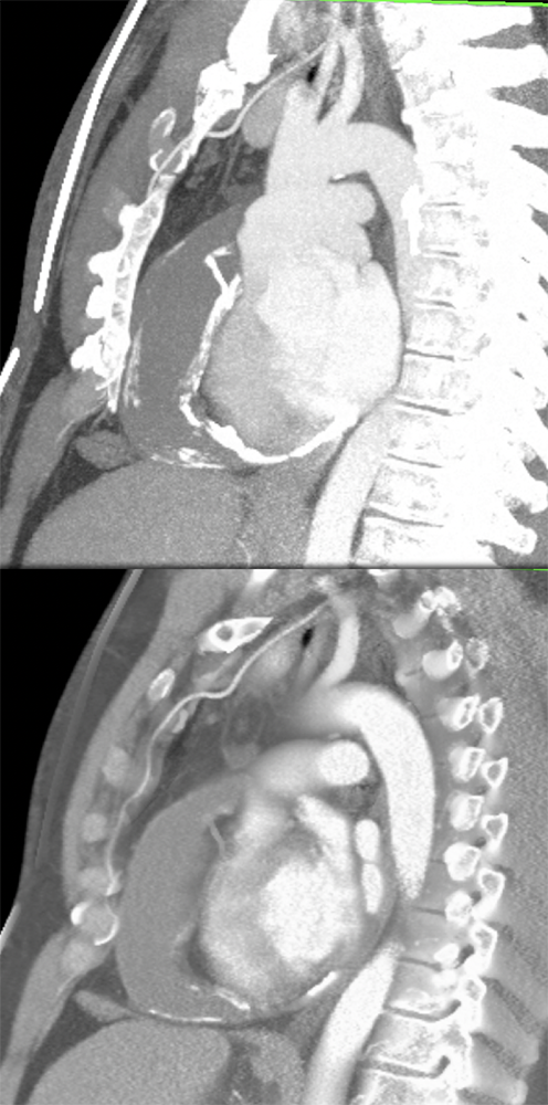 Partially Calcified Pericardial Cyst