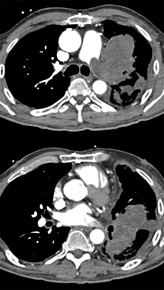 Pulmonary Artery Sarcoma