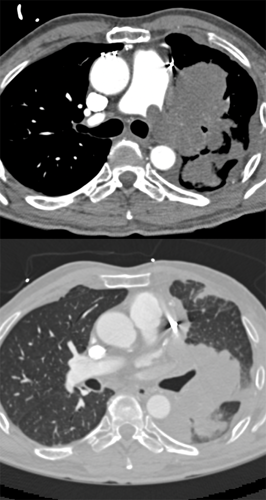 Pulmonary Artery Sarcoma