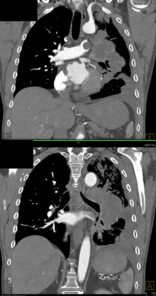 Pulmonary Artery Sarcoma