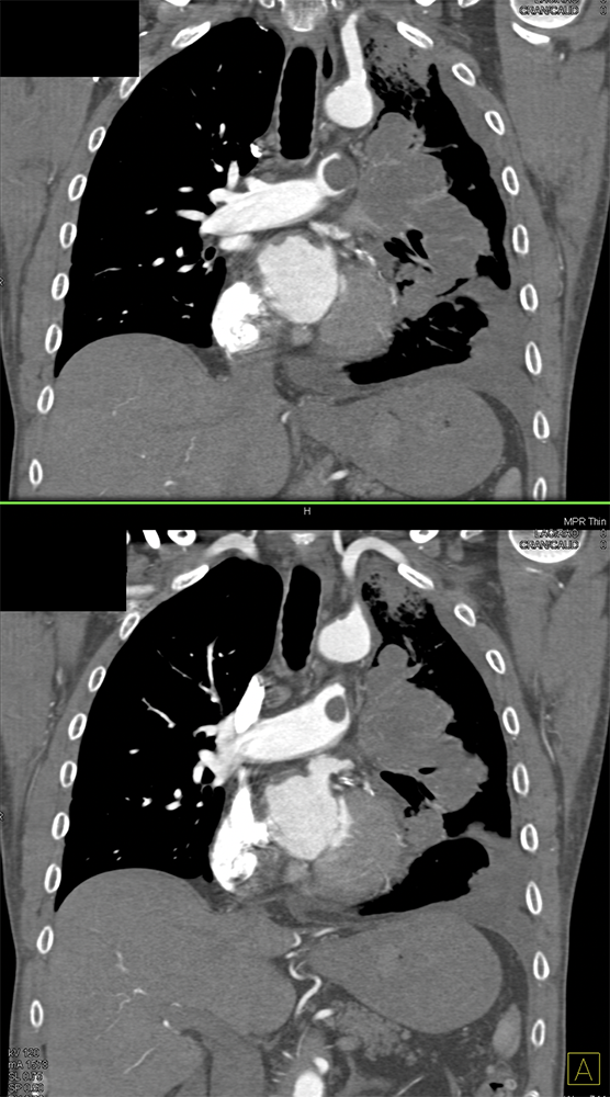 Pulmonary Artery Sarcoma