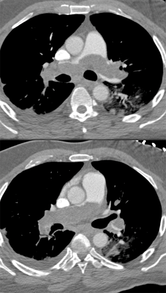 Acute Chest Pain Simulating PE was due to Pulmonary Artery Sarcoma