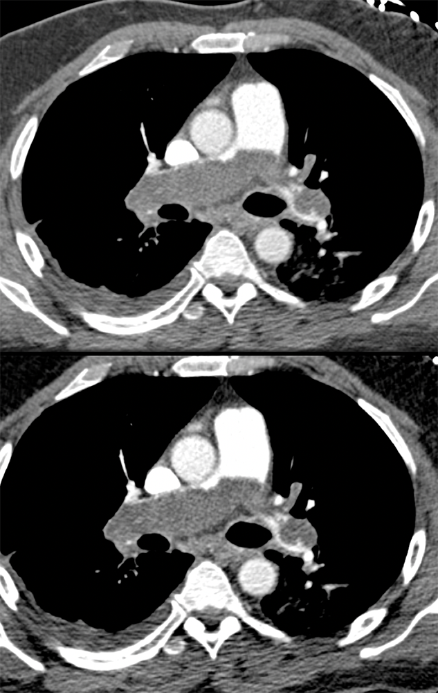 Acute Chest Pain Simulating PE was due to Pulmonary Artery Sarcoma