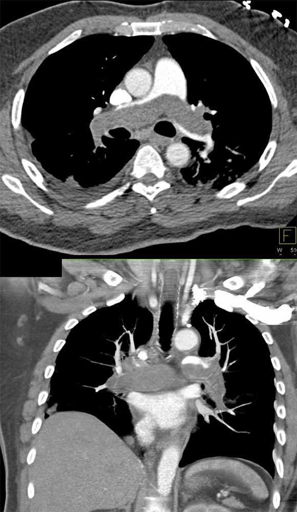 Acute Chest Pain Simulating PE was due to Pulmonary Artery Sarcoma