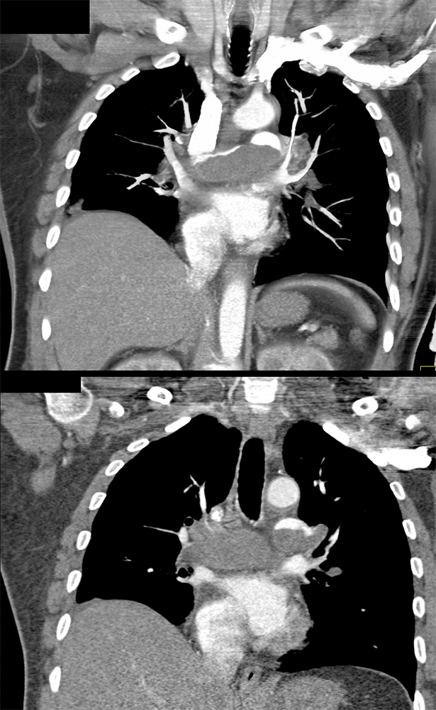 Acute Chest Pain Simulating PE was due to Pulmonary Artery Sarcoma