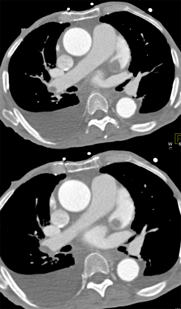 Clot in Atrial Appendage and PE