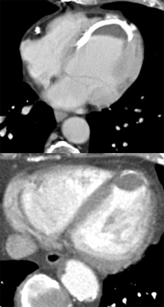 LV Thrombus