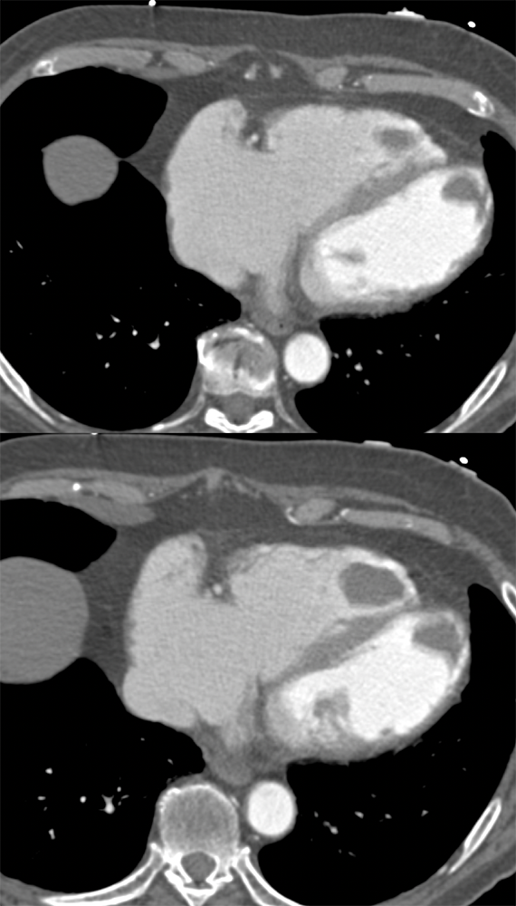 Biventricular Thrombi