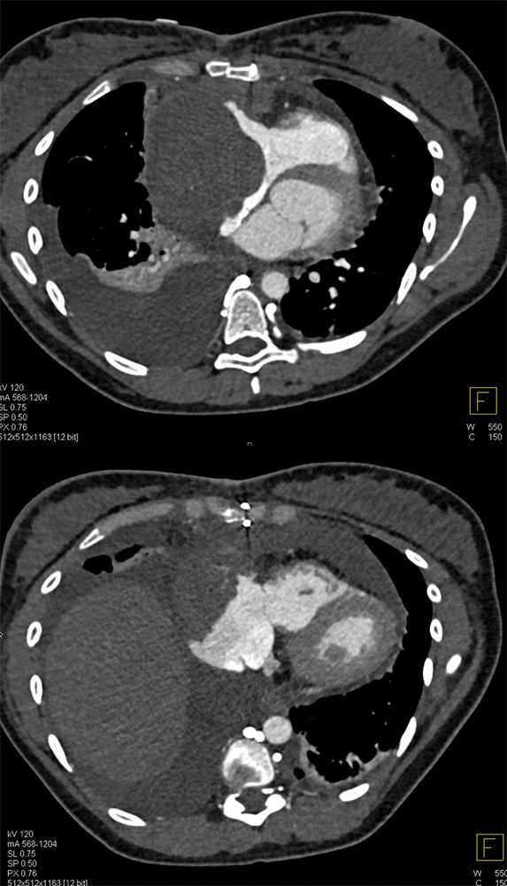 Cardiac Angiosarcoma in 26 yr old Female