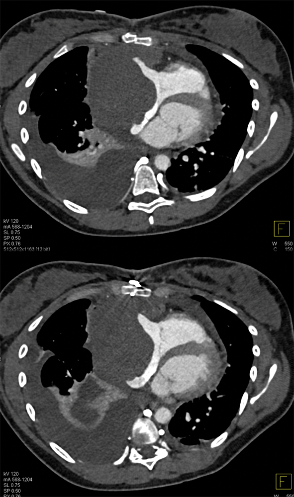 Cardiac Angiosarcoma in 26 yr old Female