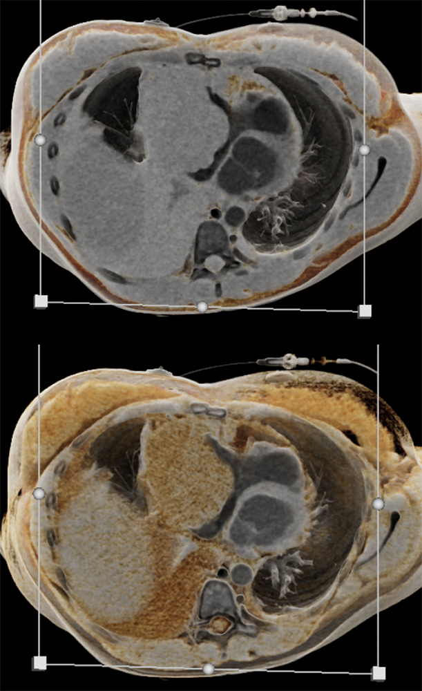 Cardiac Angiosarcoma in 26 yr old Female