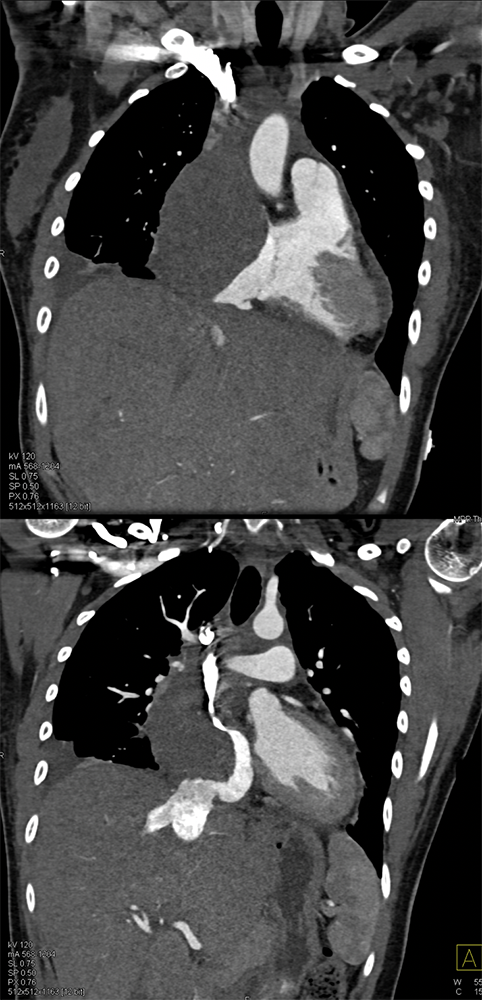 Cardiac Angiosarcoma in 26 yr old Female