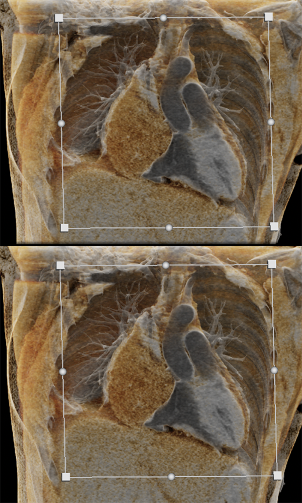 Cardiac Angiosarcoma in 26 yr old Female