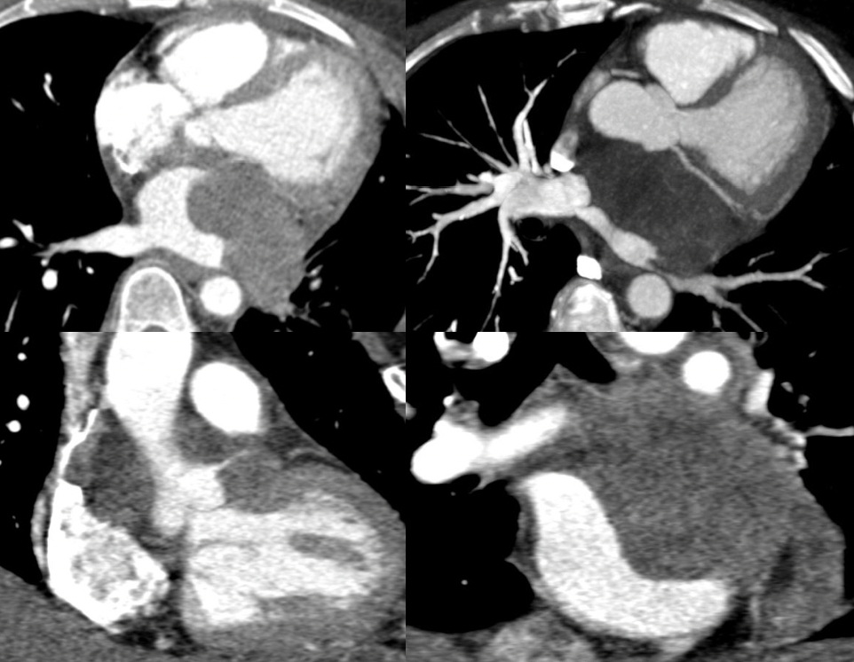 Undifferentiated Sarcoma