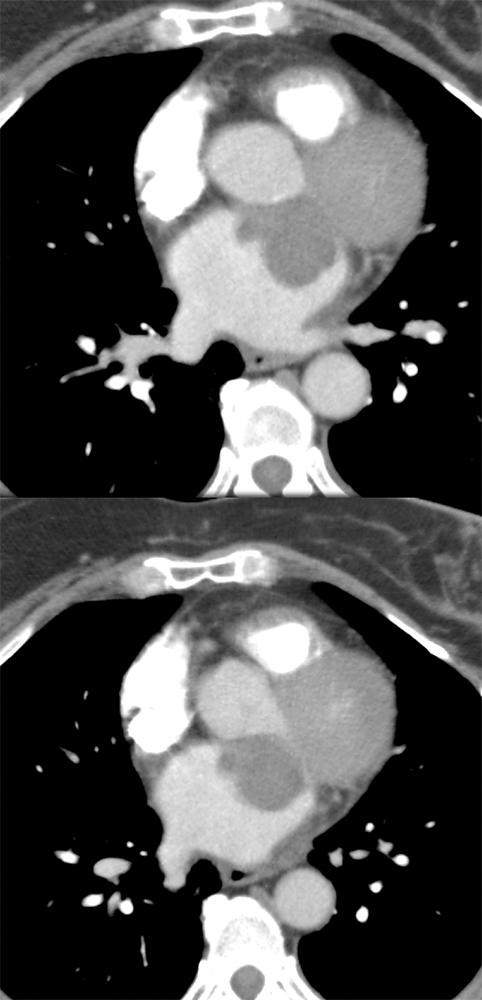 Chondroblastic Osteosarcoma in the Left Atrium