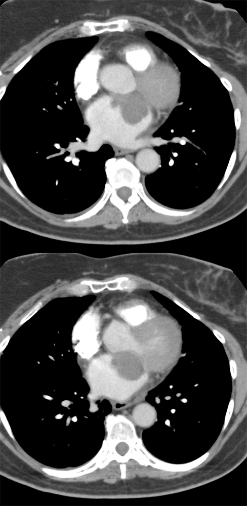 Chondroblastic Osteosarcoma in the Left Atrium