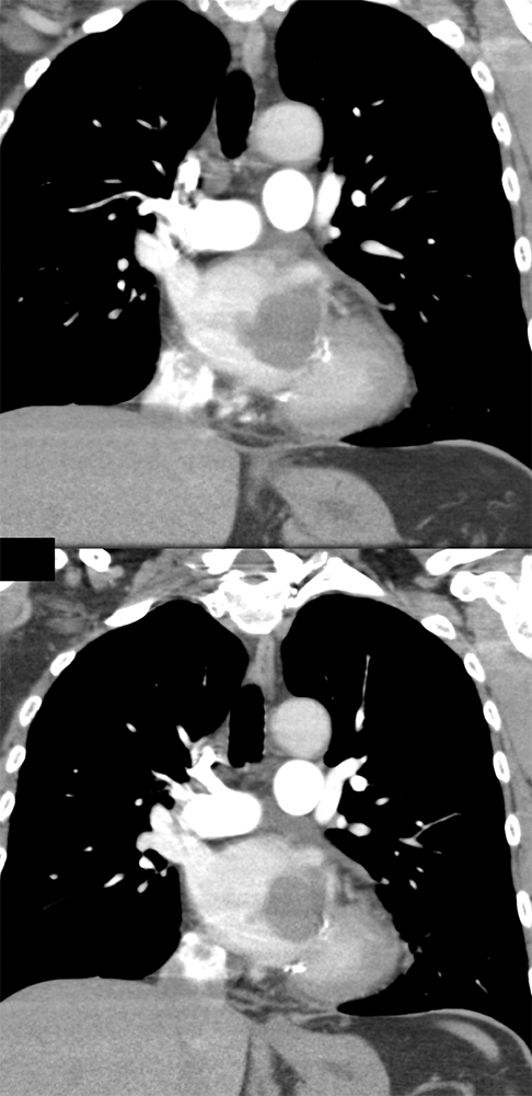 Chondroblastic Osteosarcoma in the Left Atrium