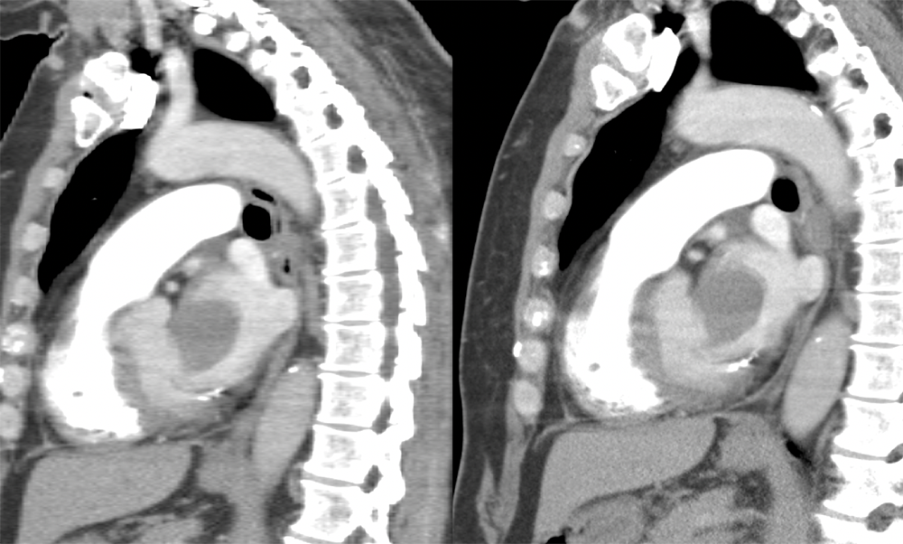 Chondroblastic Osteosarcoma in the Left Atrium