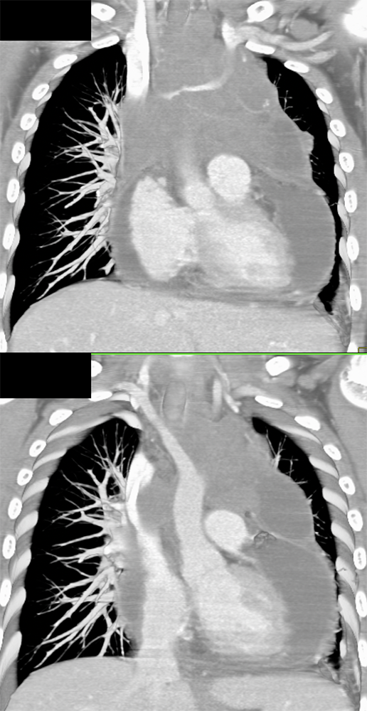 Lymphoma Involves the Pericardium