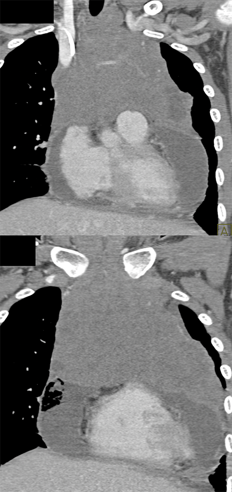 Lymphoma Involves the Pericardium