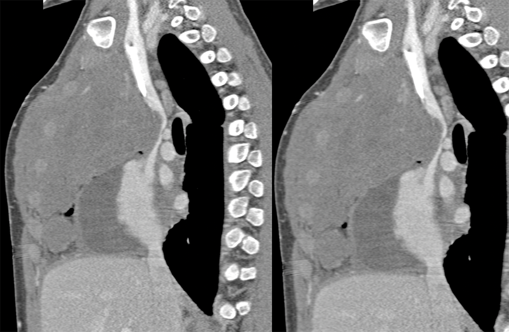 Lymphoma Involves the Pericardium