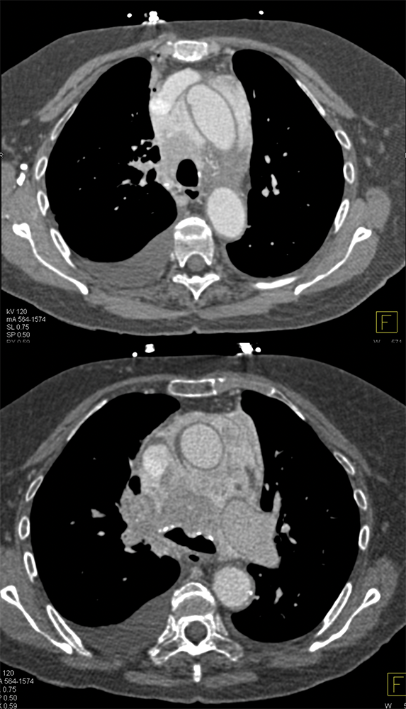 CLL with Cardiac Involvement