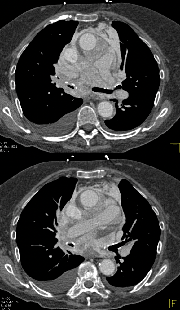 CLL with Cardiac Involvement