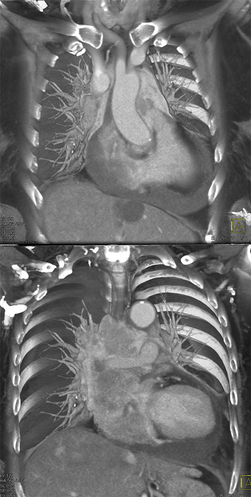 CLL with Cardiac Involvement