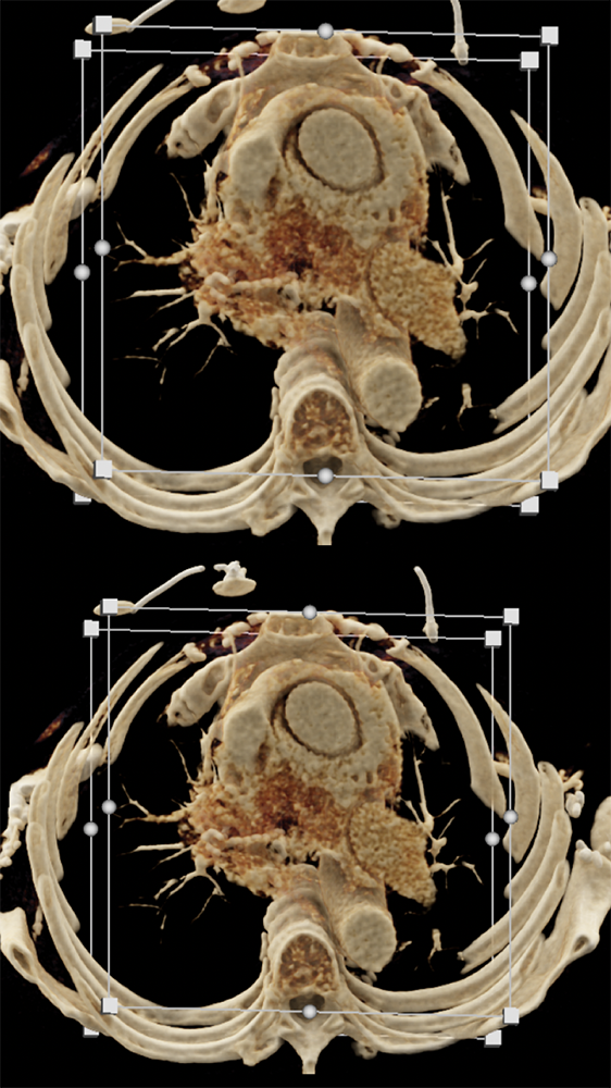 CLL with Cardiac Involvement