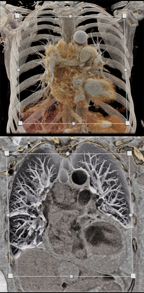 CLL with Cardiac Involvement