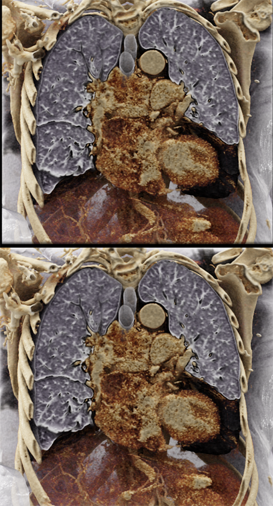 CLL with Cardiac Involvement