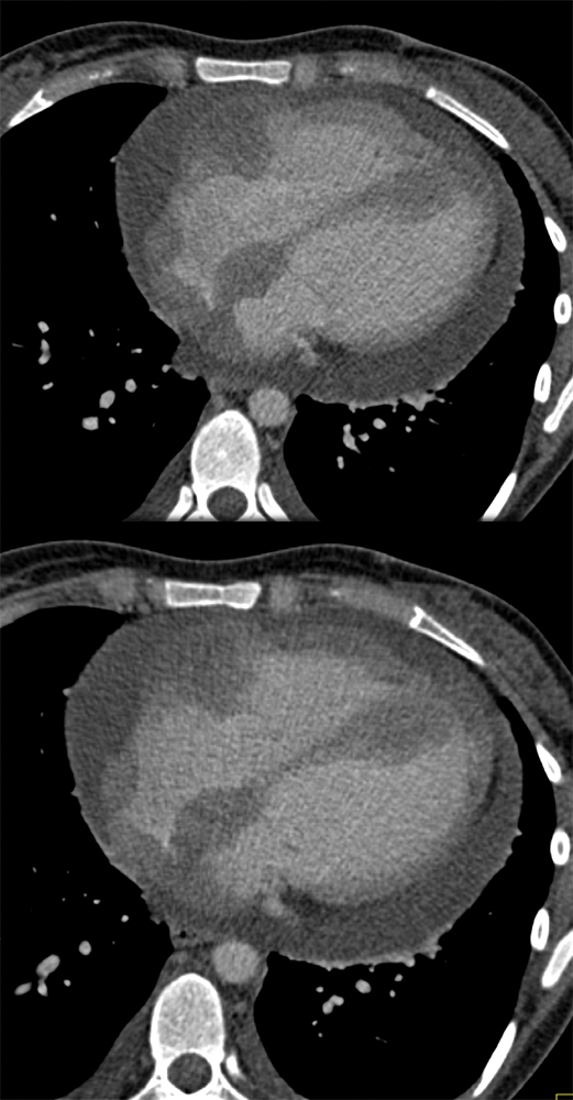 Malignant Effusion and Leukemic (ALL) Infiltrate to the  Heart (wall and pericardium)