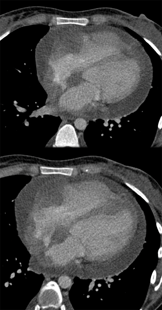 Malignant Effusion and Leukemic (ALL) Infiltrate to the  Heart (wall and pericardium)