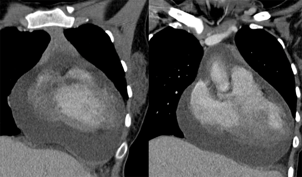 Malignant Effusion and Leukemic (ALL) Infiltrate to the  Heart (wall and pericardium)