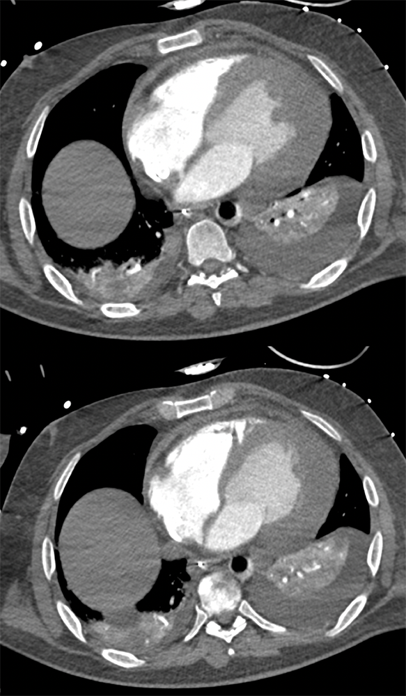 Cardiac and Renal Lymphoma