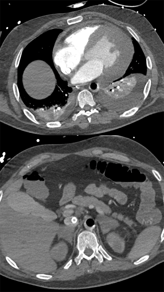 Cardiac and Renal Lymphoma