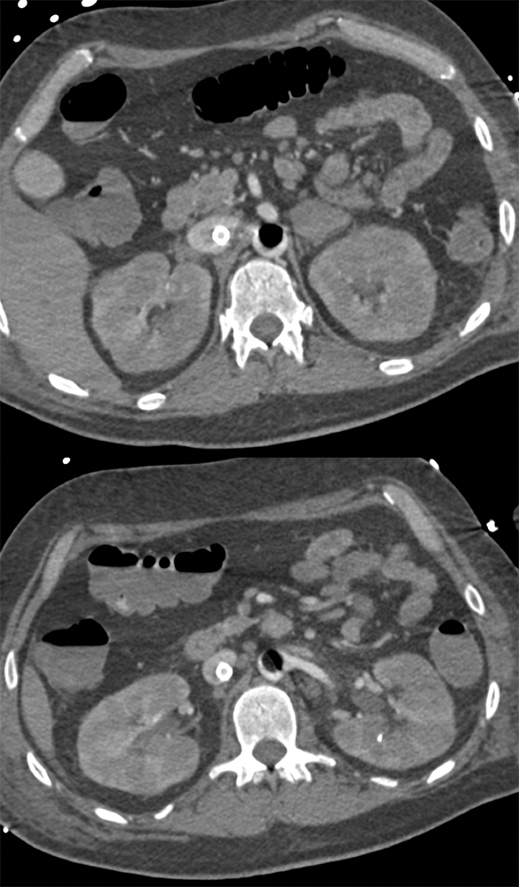 Cardiac and Renal Lymphoma