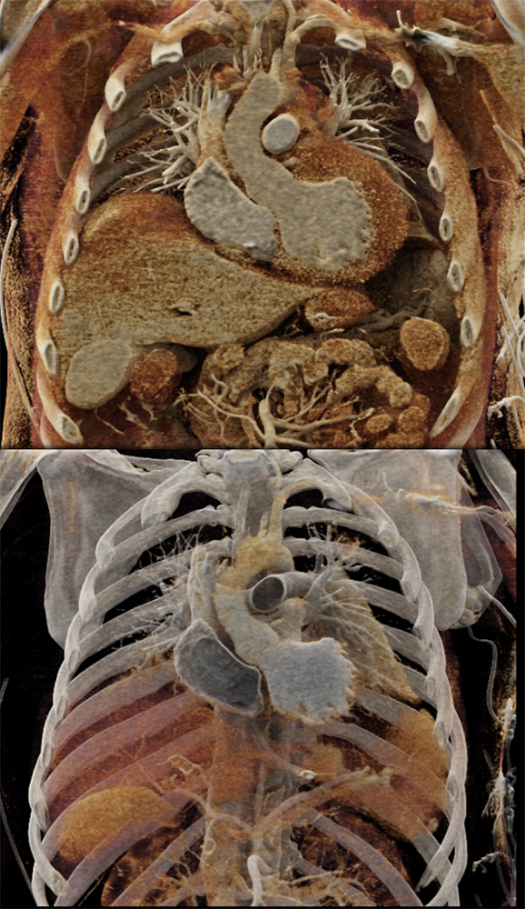 Cardiac and Renal Lymphoma