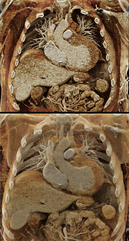 Cardiac and Renal Lymphoma