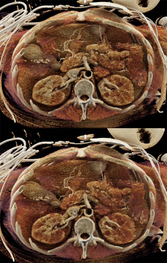 Cardiac and Renal Lymphoma