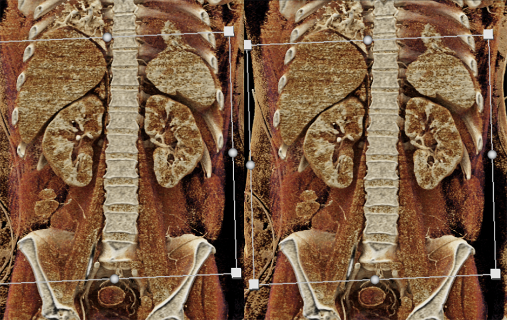 Cardiac and Renal Lymphoma